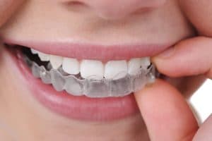 woman inserting clear aligner into mouth