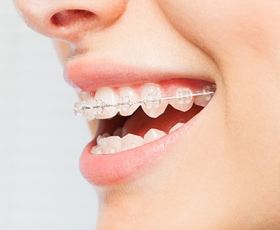 Ceramic braces at Moss Wall Orthodontics in Lacey, WA