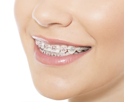 Metal braces at Moss Wall Orthodontics in Lacey, WA