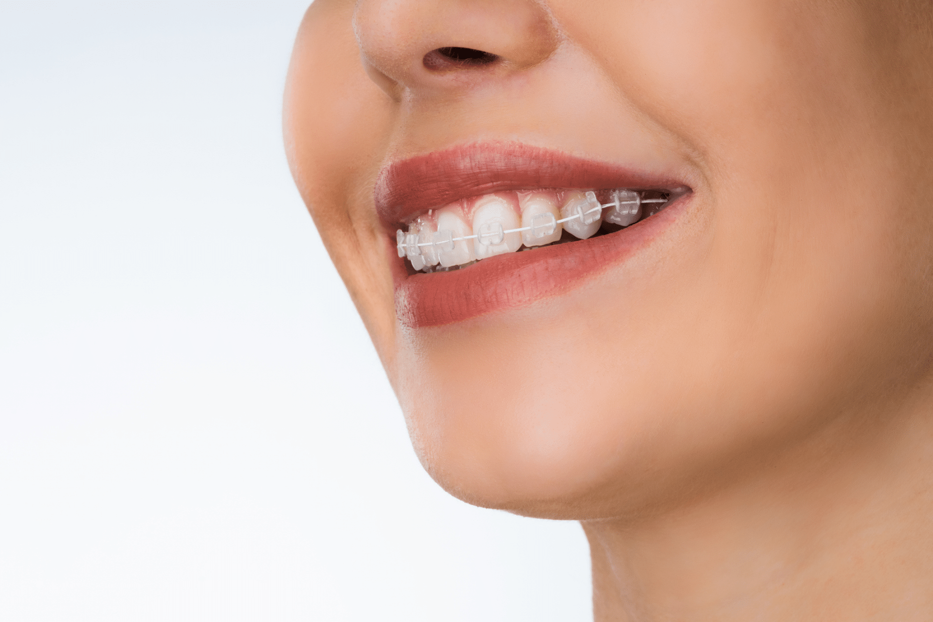 A close-up side view of a person's smile with clear, tooth-colored dental braces on their upper teeth.